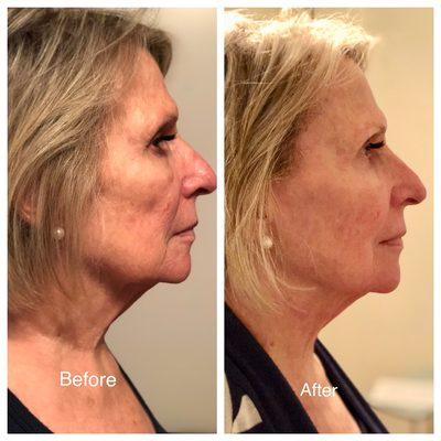 Before and after 1 Slender Wave cosmetic ultrasound anti-aging facial treatment on the face and neck.