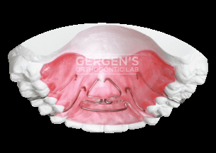 Spring Aligner fabricated in the USA by David Gergen from Gergen's Orthodontic Lab