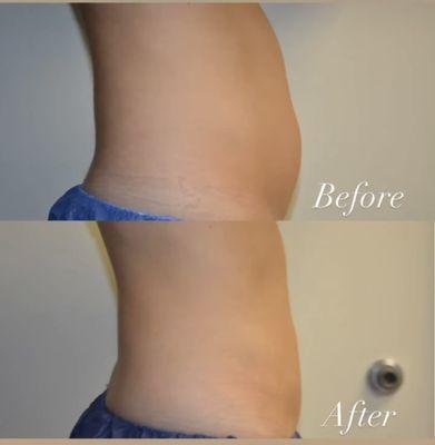 Coolsculpting of the upper and lower abdomen and flanks.