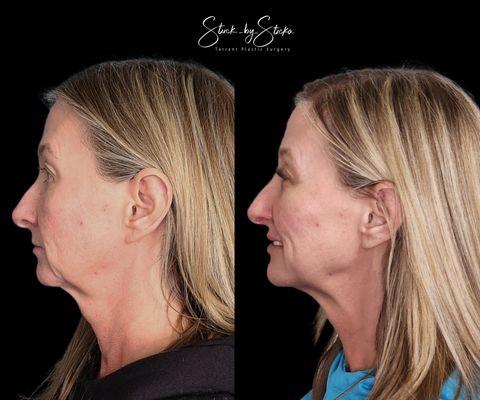 Full face rejuvenation with Botox and Juvederm Filler