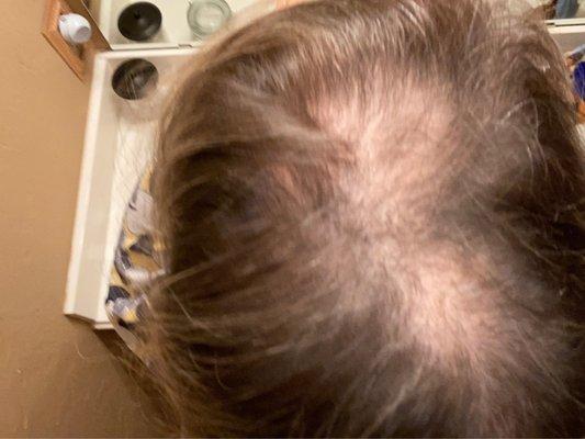 My head showing hair loss