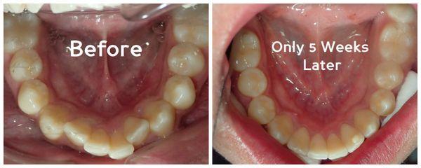 Before and after picture of teeth-straightening treatment with Inman Aligners. Click here to see how they work https://www.yo...