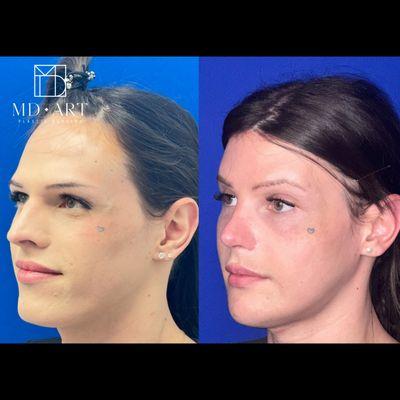 Facial Feminization