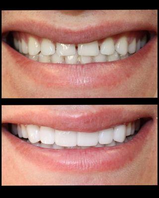 Veneers and Crowns