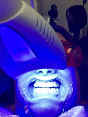 Teeth whitening