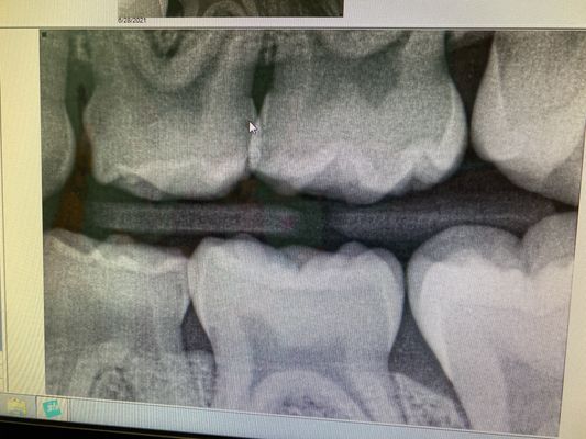 arrow on the ONE cavity I was shown she had