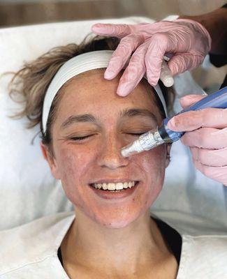 Koru Med Spa is the first clinic to offer SkinPen microneedling, the first and only FDA approved medical microneedling pen.