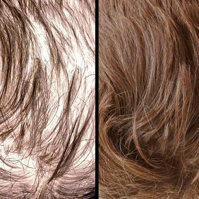 Hair Restoration with DE|RIVE - Enhances the appearance of fuller, thicker hair.