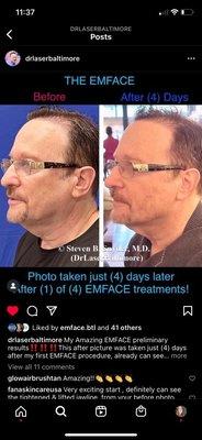 Emface after just one treatment (of 4.)  Revolutionary!!!!