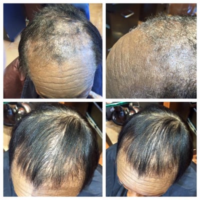 This client start treatment May 30th to August 1 2015. She is very please. Do you know someone with this problem?