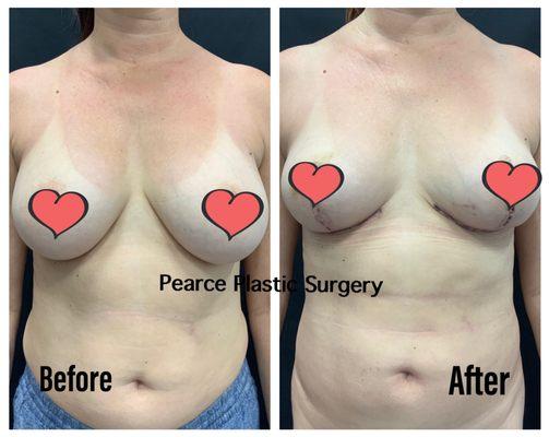 Breast Implant removal with lift