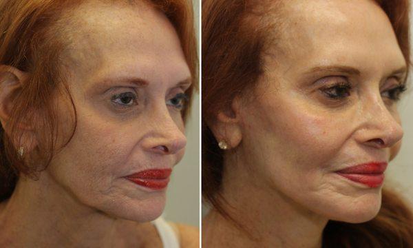 Facelift with fat grafting