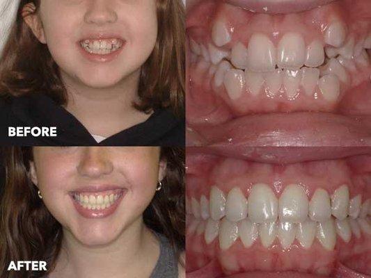 before and after with Invisalign