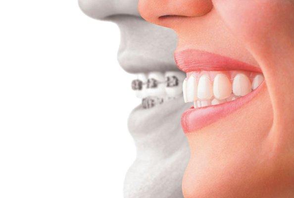 Invisalign VS. Traditional Braces