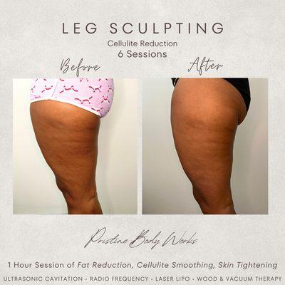 Cellulite can be tough to get rid of and takes time! Here a few sessions of reducing this cellulite.