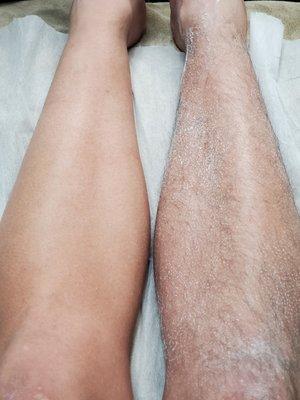 Mens leg Before and after