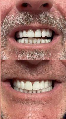 Smile makeover done by Dr. Dawood