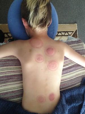 Get those sore muscles fire cupped! (For adults too!)