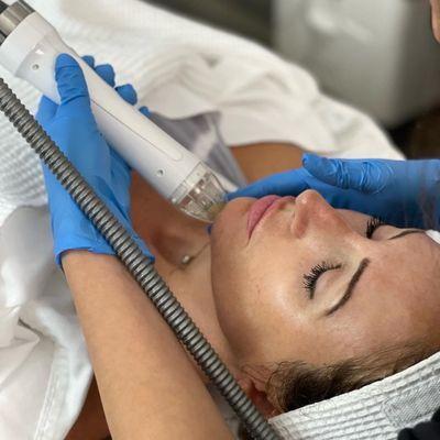 Vivace RF Microneedling