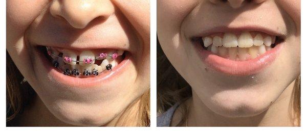 Before and after of my daughter's teeth. Great work!