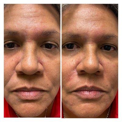 Before & After Reduction of Nasolabial Fold & Marionette Lines With Dermal Filler