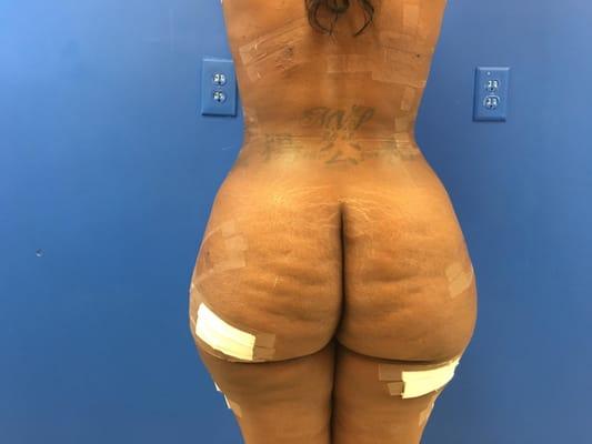 Liposuction/ Brazilian Butt lift, 10 day post-op picture 7/5/16