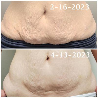 Real local results.  2x a week for 20 minutes with this 6 week program, resulted in forming and lifting the Belly skin.