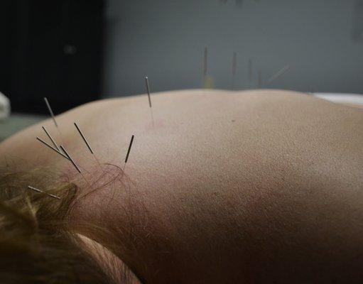 Acupuncture