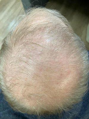 Hair Rejuvenation- After 1 treatment