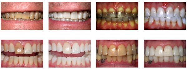 The KöR System is comfortable and 100% safe for your teeth and gums. The result is a radiantly white, natural appearing smile. Call us now!