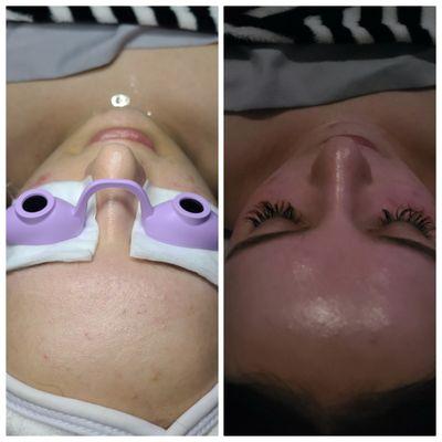 EUROPEAN FACIAL [1 hour]
Duration 1.5 hours with add on: microdermabrasion