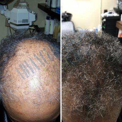 Androgenetic Alopecia - treatment program available