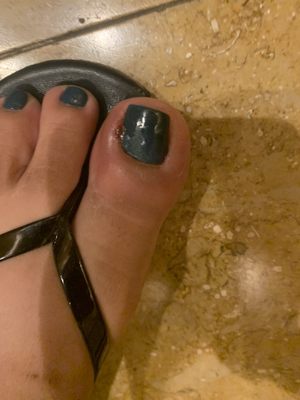 infected toes from pedicure here please be careful