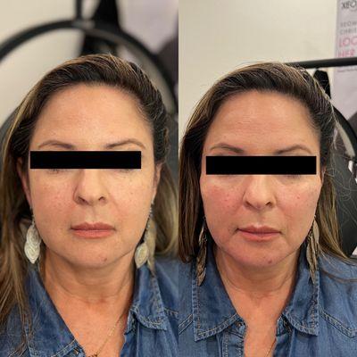 Cheeks + jawline filler with Radiesse