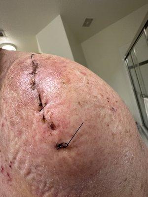 8 days after resection surgery for left shoulder