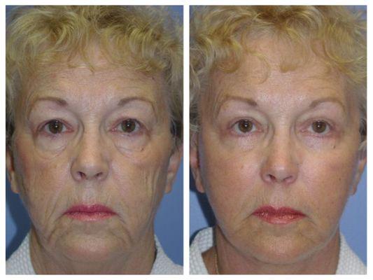 Face Lift and Fat Grafting Before and After Results by Haven J. Barlow, MD, FACS