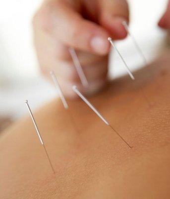 Acupuncture needles to rebalance energy.