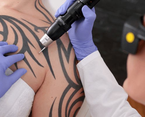 Laser Tattoo
Removal