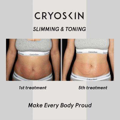 5 treatments (3 slimming and 2 toning(tightening)) of cryotherapy (fat freezing) on the abdomen