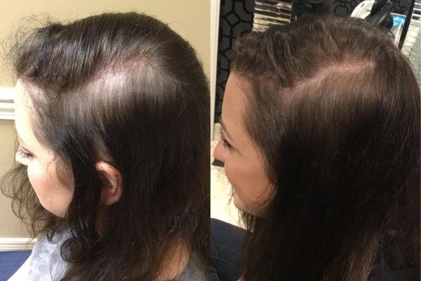 Microneedling with Exosomes for hair growth