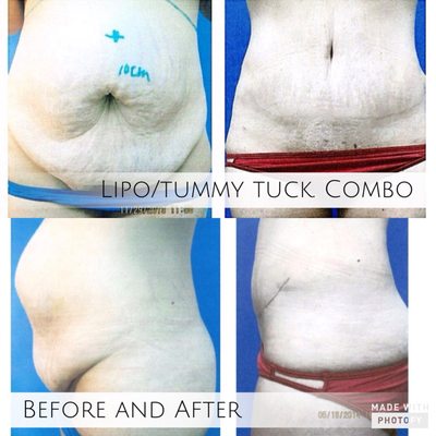 Lipo/tummy tuck combo