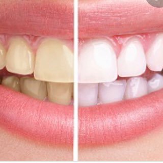 Teeth Whitening Services