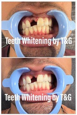 Getting the teeth whitened before the implant crown delivery