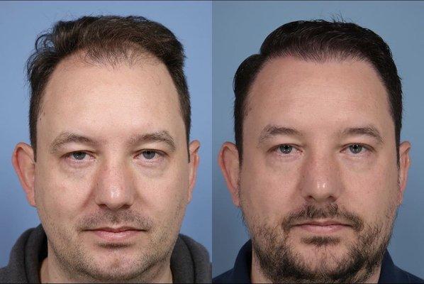 FUE Hair Restoration before and after