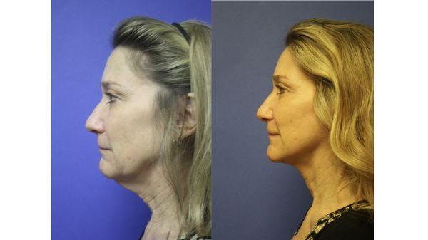 Mini Face and Neck Lift Before and After