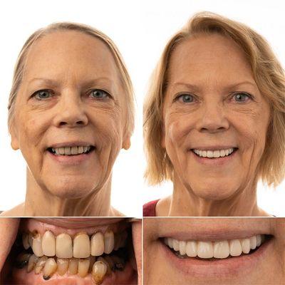 Beautiful before/after with Full Mouth Implants