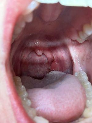 Strep throat! Why lump on my left tonsil. They didn't even take the time to look in my throat and denied testing me