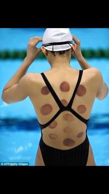 Ever wonder what those round marks are on the Olympians? It is called cupping and it help alleviate sore tense muscles and trigger pts.