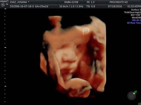 PROCREATE 4D  High Definition Ultrasound Scan, (HD LIVE) little baby girl 32 weeks.