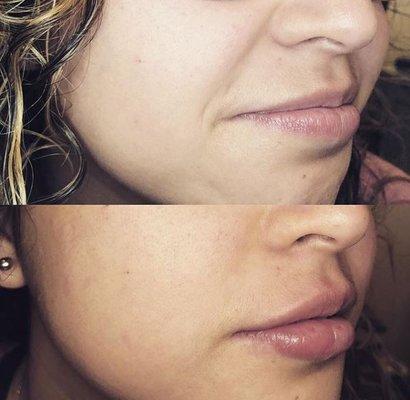 Juvederm Lips